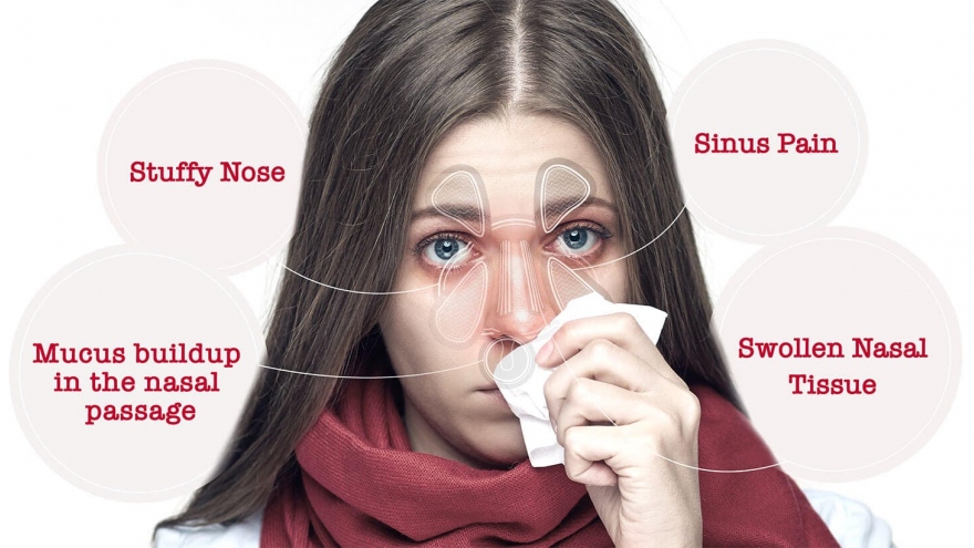 Không nên tùy tiện dùng thuốc để trị ngạt mũi